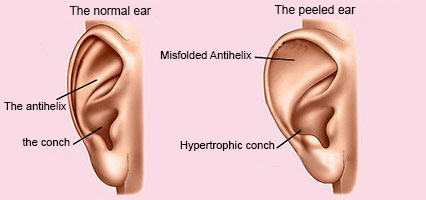 Protruding-ears